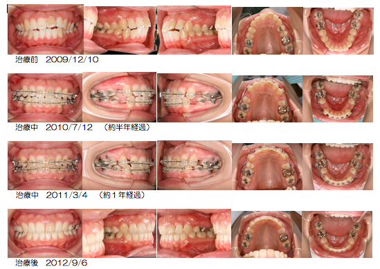 矯正治療体験談 At 清村矯正歯科