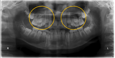 乳歯 レントゲン