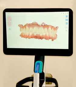 マウスピース型矯正装置